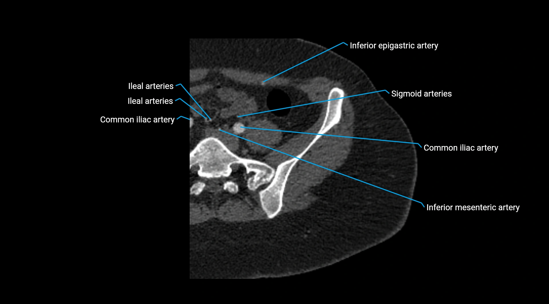 CTA lower limb cross sectional anatomy labelled image _16.webp
